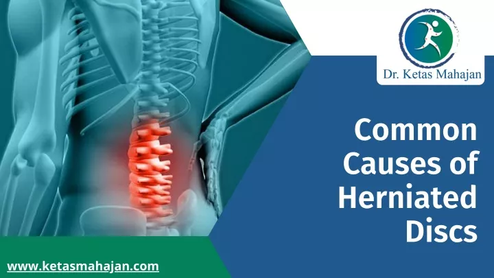 common causes of herniated discs