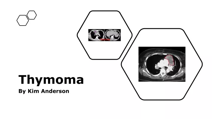 thymoma