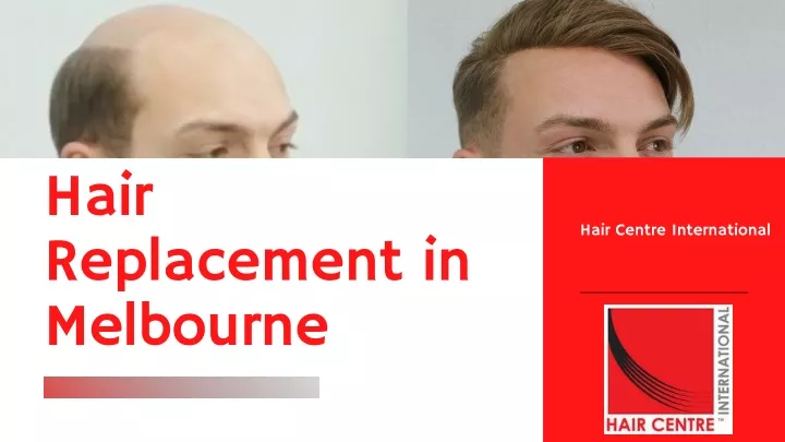 hair replacement in melbourne