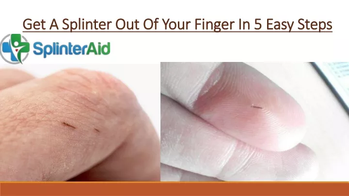 get a splinter out of your finger in 5 easy steps