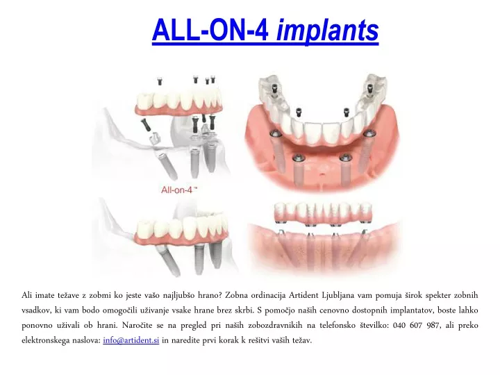 all on 4 implants