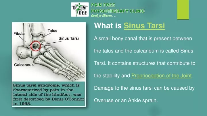 what is sinus tarsi