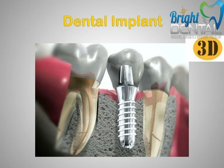PPT - 3D Printed Dental Implant PowerPoint Presentation, free download ...