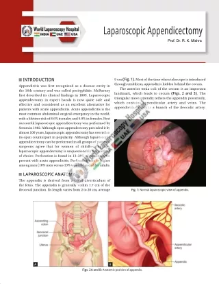 Laparoscopic-Appendicectomy