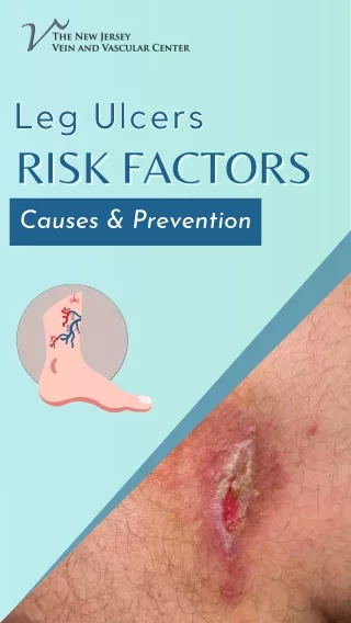 A Comprehensive Guide to Leg Ulcers
