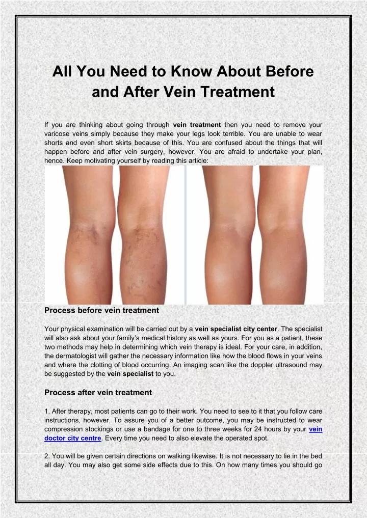all you need to know about before and after vein