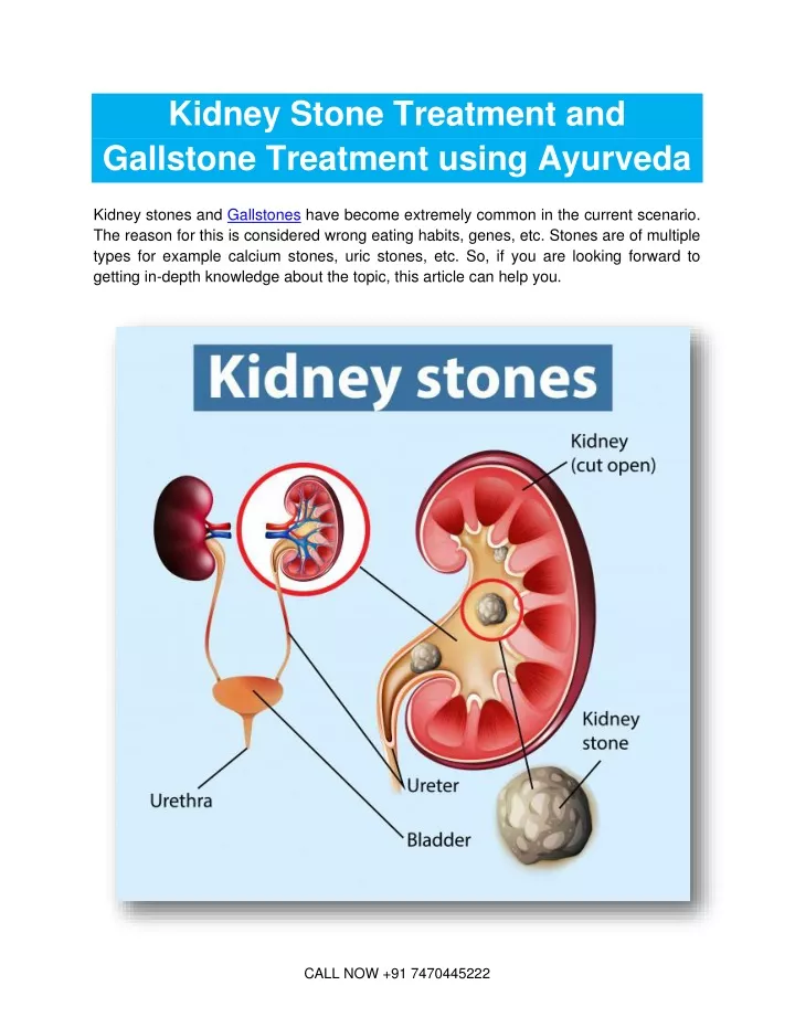 kidney stone treatment and gallstone treatment