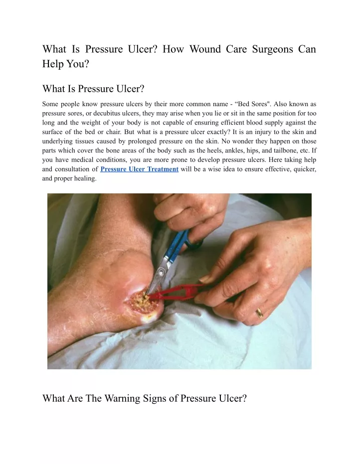 what is pressure ulcer how wound care surgeons