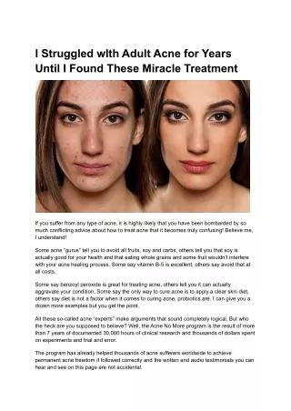 I Struggled wIth Adult Acne for Years Until I Found These Miracle Treatment