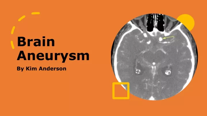 brain aneurysm