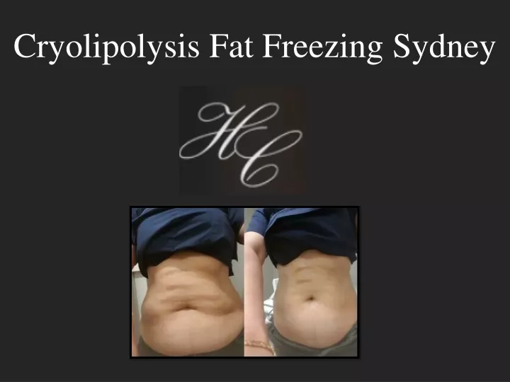 cryolipolysis fat freezing sydney
