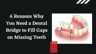 6 Reasons Why You Need a Dental Bridge to Fill Gaps on Missing Teeth