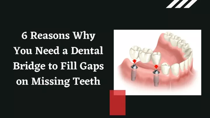 6 reasons why you need a dental bridge to fill