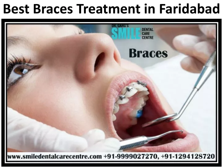 best braces treatment in faridabad