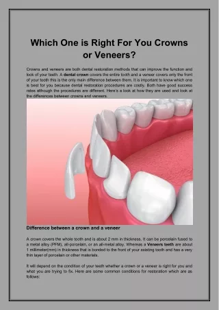 Which One is Right For You Crowns or Veneers