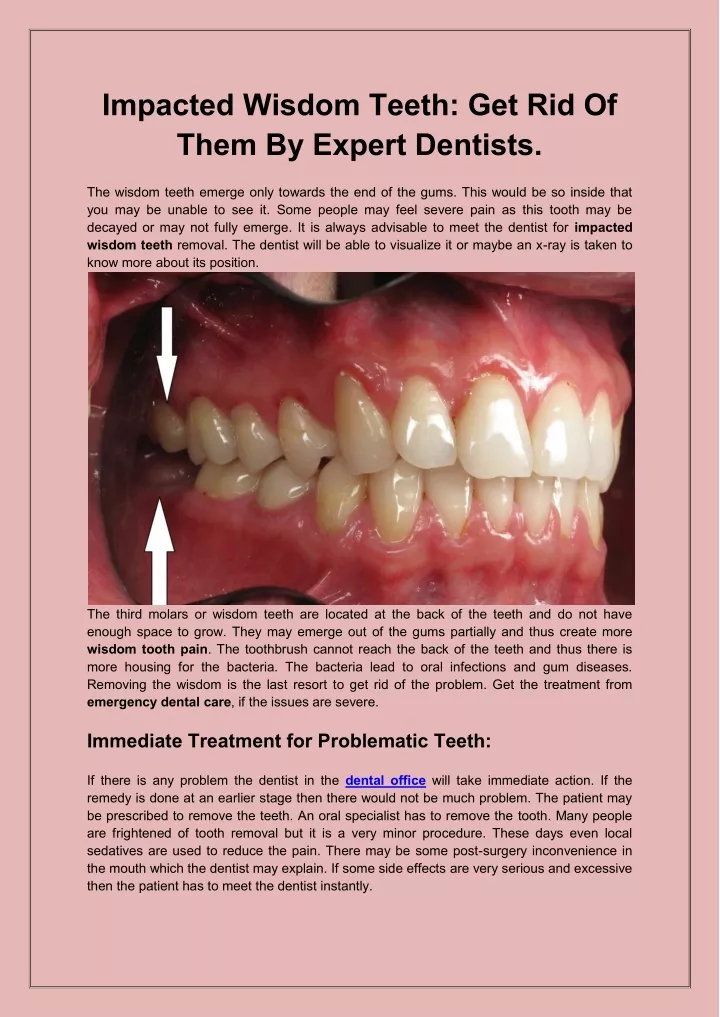 impacted wisdom teeth get rid of them by expert