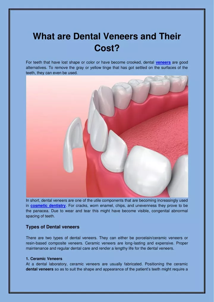 what are dental veneers and their cost