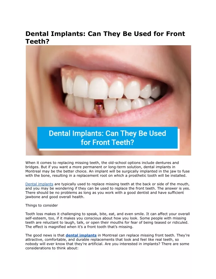 dental implants can they be used for front teeth