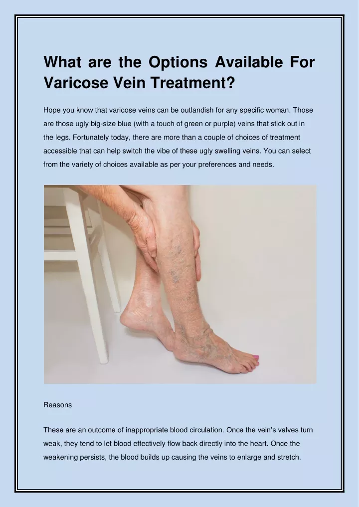 what are the options available for varicose vein