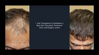Hair Transplant in Coimbatore | Best Hair Transplant Treatment Clinic
