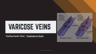 Best Varicose Veins Center in Surat - Varicose Veins Hospital in Surat