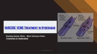 Varicose Veins treatment in Hyderabad