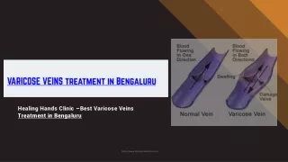 Best Varicose Veins Center in Bengaluru - Varicose Veins Hospital in Bengaluru