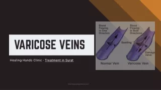 Best Varicose Veins Center in Surat - Varicose Veins Hospital in Surat