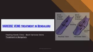 Varicose Veins Hospital in Bengaluru - Varicose Veins operation in Bengaluru