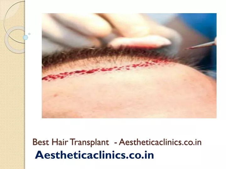 best hair transplant aestheticaclinics co in