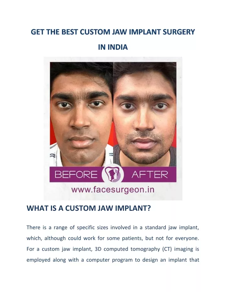 what is a custom jaw implant