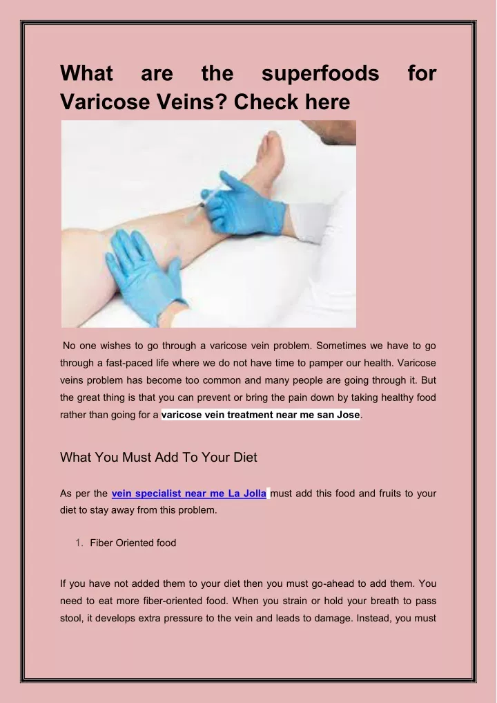 what varicose veins check here