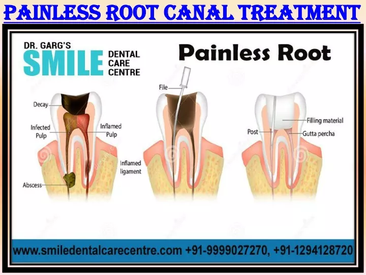 painless root canal treatment