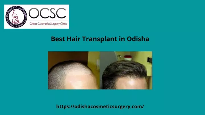 best hair transplant in odisha