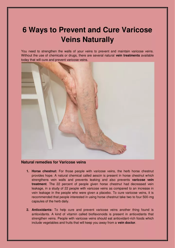 6 ways to prevent and cure varicose veins