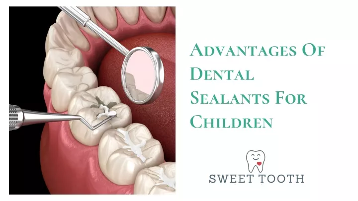 advantages of dental sealants for children