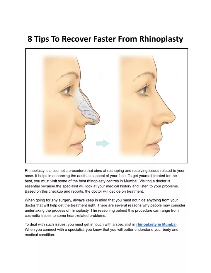 8 tips to recover faster from rhinoplasty
