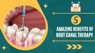 5 Amazing Benefits of Root Canal Therapy