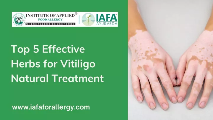 top 5 effective herbs for vitiligo natural