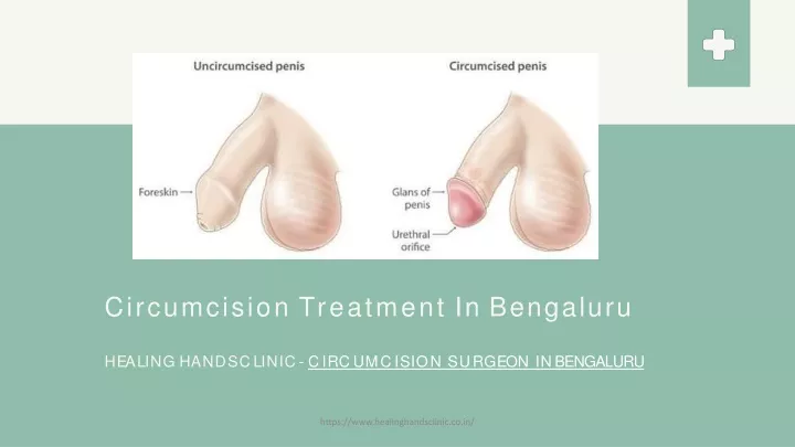 circumcision treatment in bengaluru