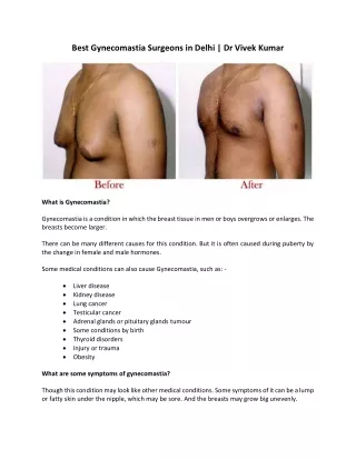 Best Gynecomastia Surgeons in Delhi Dr Vivek Kumar