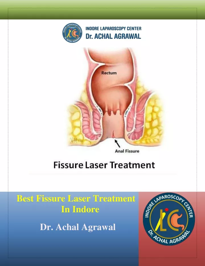 best fissure laser treatment in indore dr achal