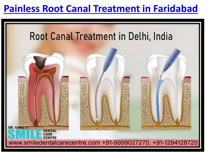 painless root canal treatment in faridabad