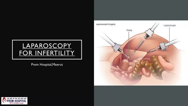 laparoscopy for infertility