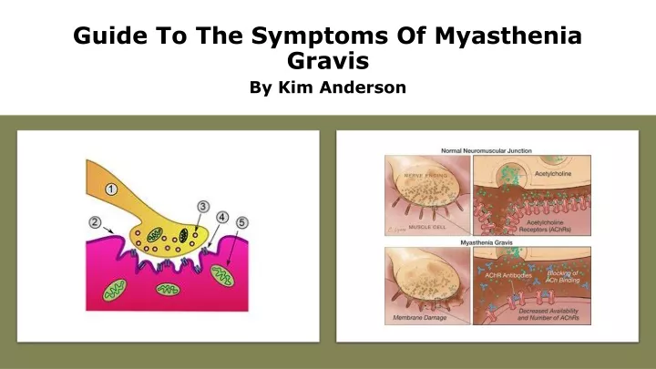 guide to the symptoms of myasthenia gravis