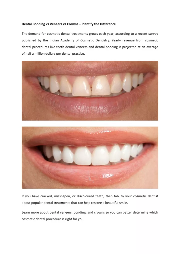 dental bonding vs veneers vs crowns identify
