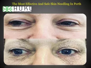 The Most Effective And Safe Skin Needling In Perth