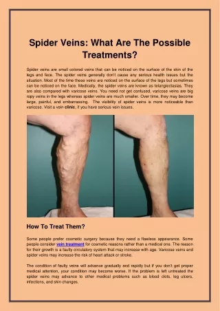 Spider Veins What Are The Possible Treatments