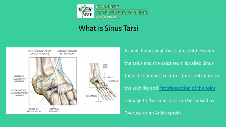 what is sinus tarsi