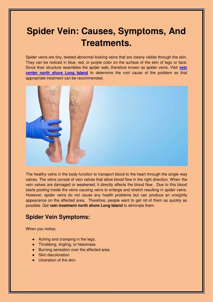 spider vein causes symptoms and treatments spider